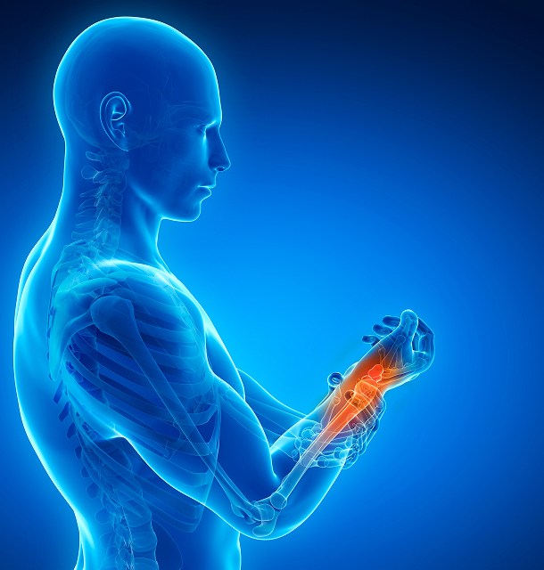 손목터널증후군