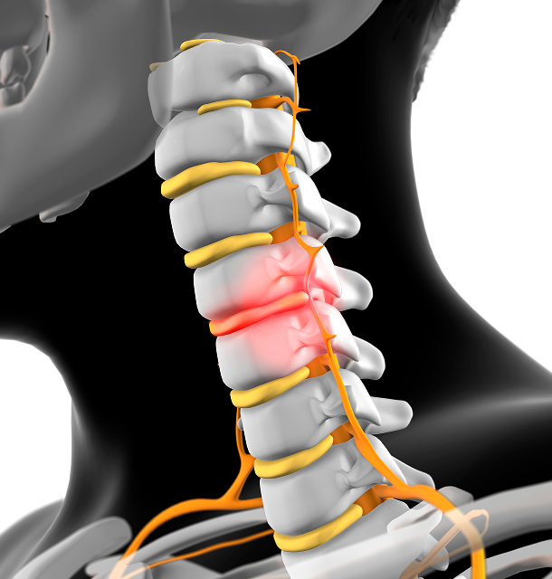 경추후관절증후군